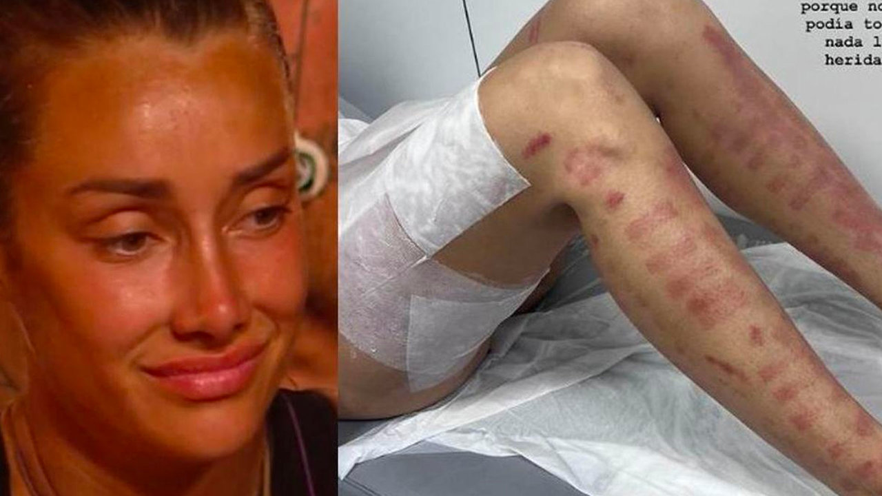 Adara Molinero denunciará a la clínica que le trató las piernas y le ha provocado quemaduras de segundo grado