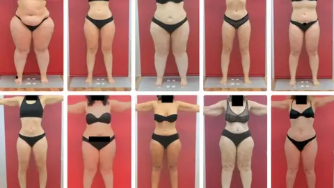Qu&eacute; es el Lipedema y qu&eacute; tratamientos existen